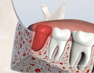 Wisdom Teeth Removal Illustration