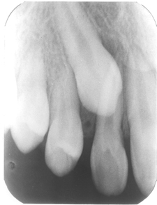 Impacted Canine X-Ray