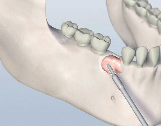 Bone Grafting Illustration