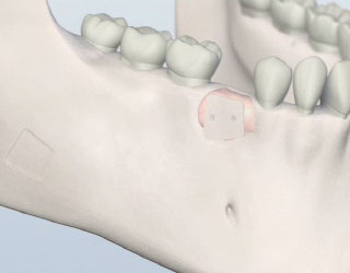 Bone Grafting Illustration