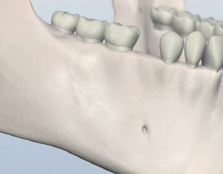 Bone Grafting Illustration