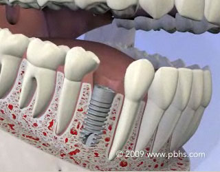 Dental Implants Illustration