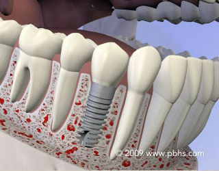 Dental Implants Illustration