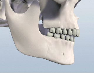 Jaw Surgery Illustration