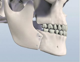 Jaw Surgery Illustration