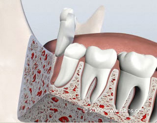 Wisdom Teeth Removal Illustration