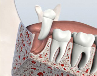 Wisdom Teeth Removal Illustration